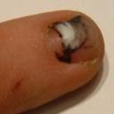 smashed finger nail 2003